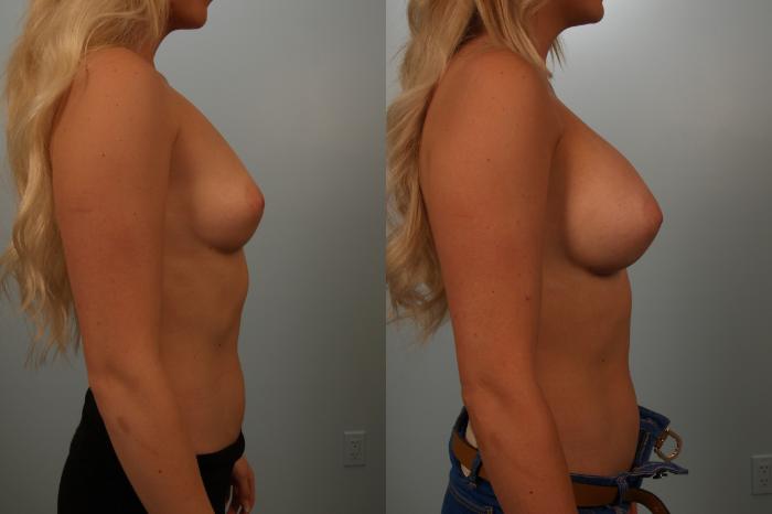 Before & After Breast Augmentation Case 151 View #3 View in Gilbert, AZ