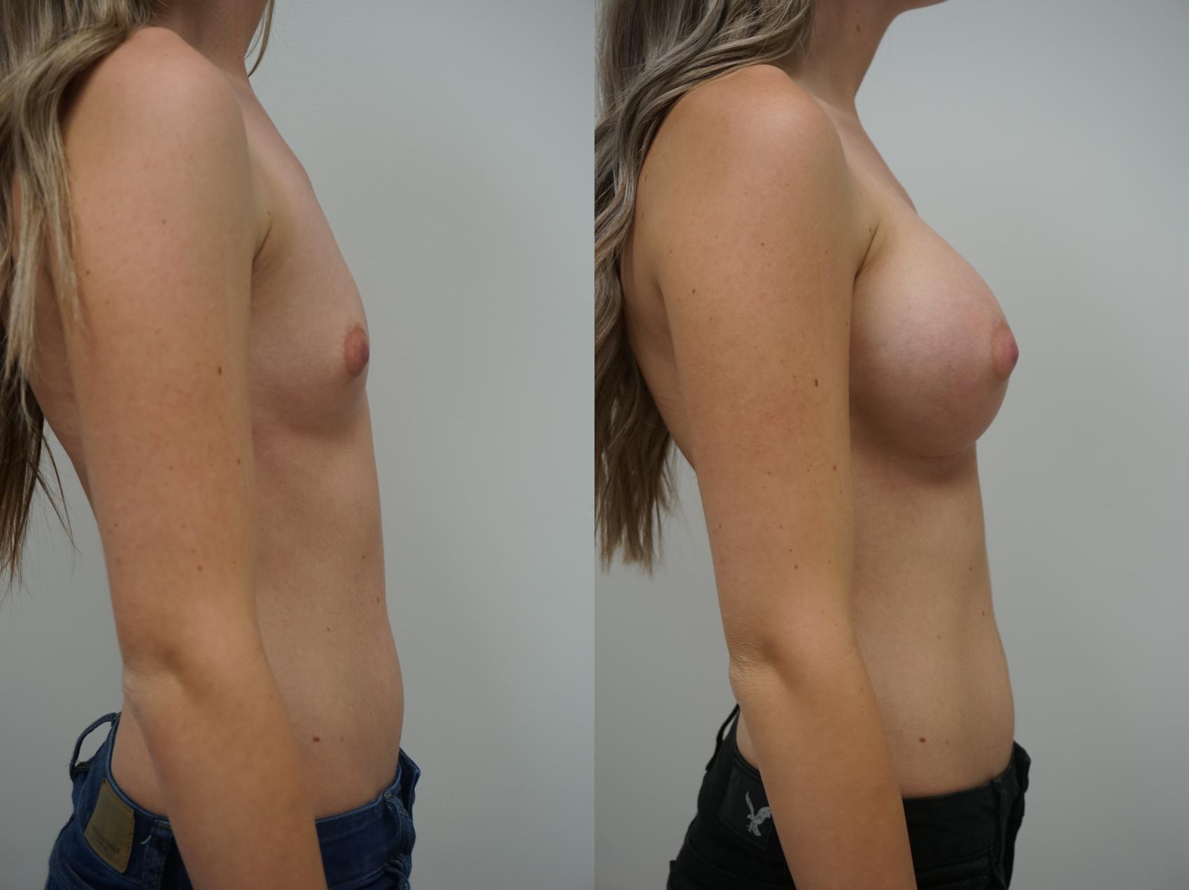 Before & After Breast Augmentation Case 160 View #2 View in Gilbert, AZ