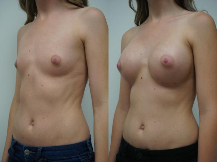 Before & After Breast Augmentation Case 160 View #3 View in Gilbert, AZ