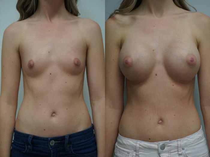 Before & After Breast Augmentation Case 160 View #4 View in Gilbert, AZ