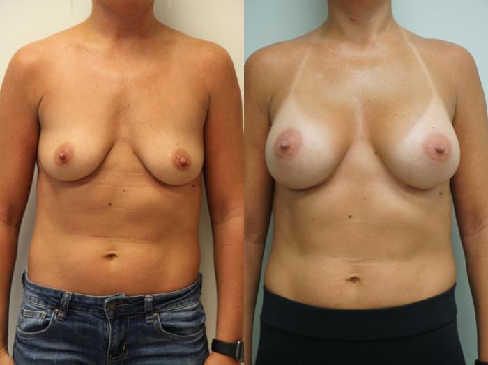 Before & After Breast Augmentation Case 162 View #1 View in Gilbert, AZ