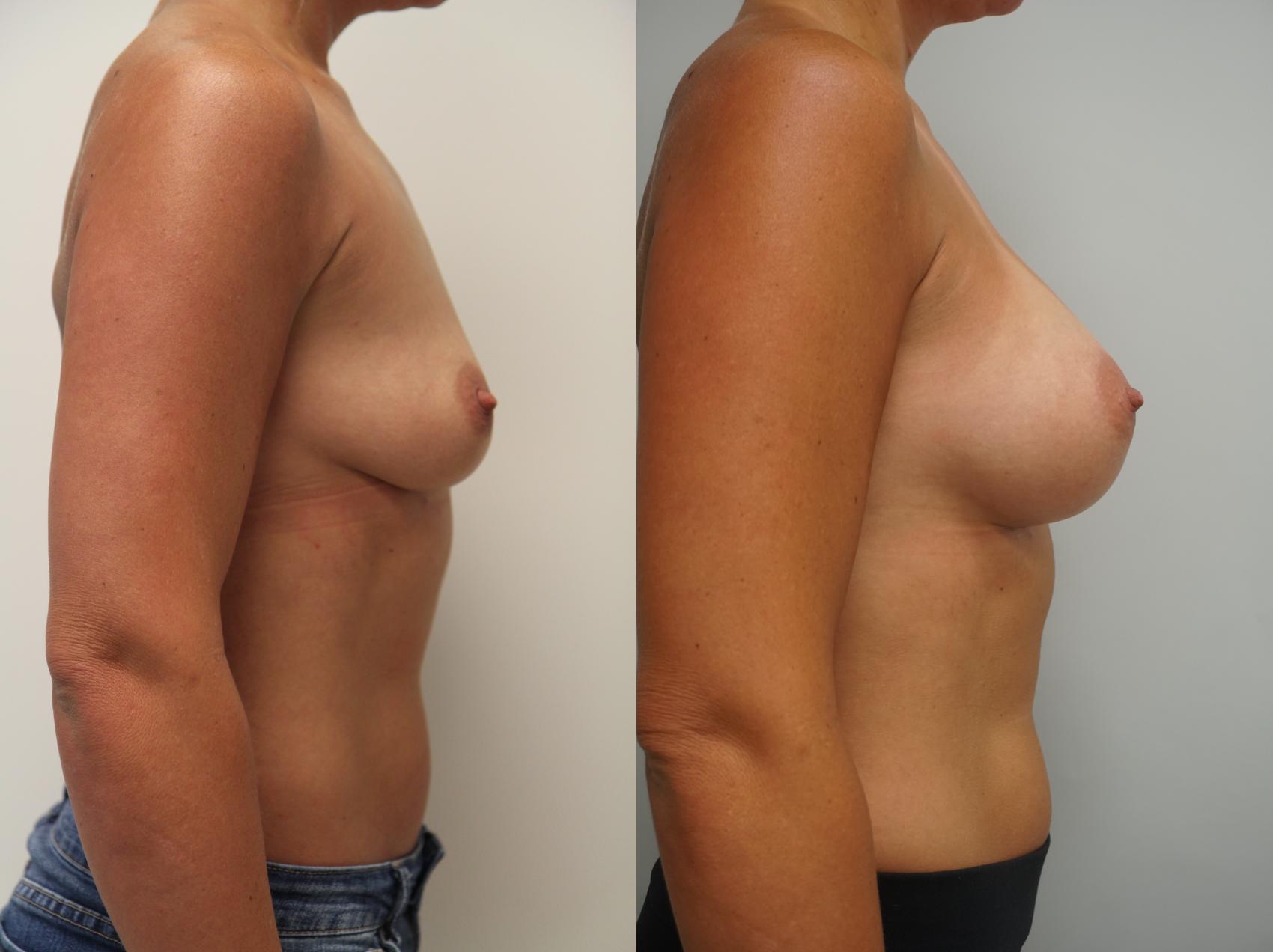 Before & After Breast Augmentation Case 162 View #2 View in Gilbert, AZ