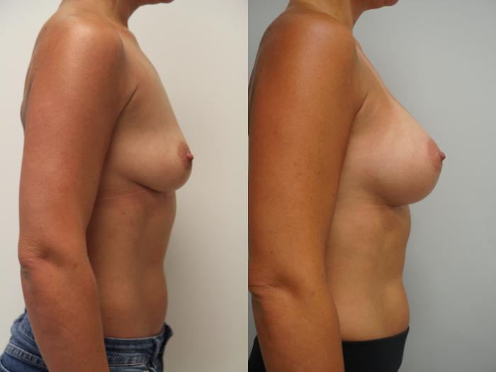 Before & After Breast Augmentation Case 162 View #2 View in Gilbert, AZ