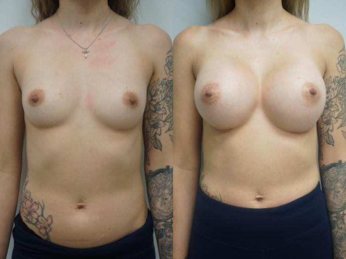 Before & After Breast Augmentation Case 166 View #1 View in Gilbert, AZ