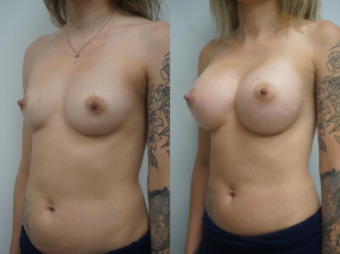 Before & After Breast Augmentation Case 166 View #2 View in Gilbert, AZ