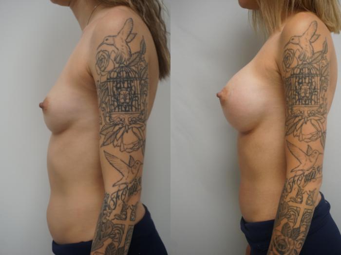 Before & After Breast Augmentation Case 166 View #3 View in Gilbert, AZ