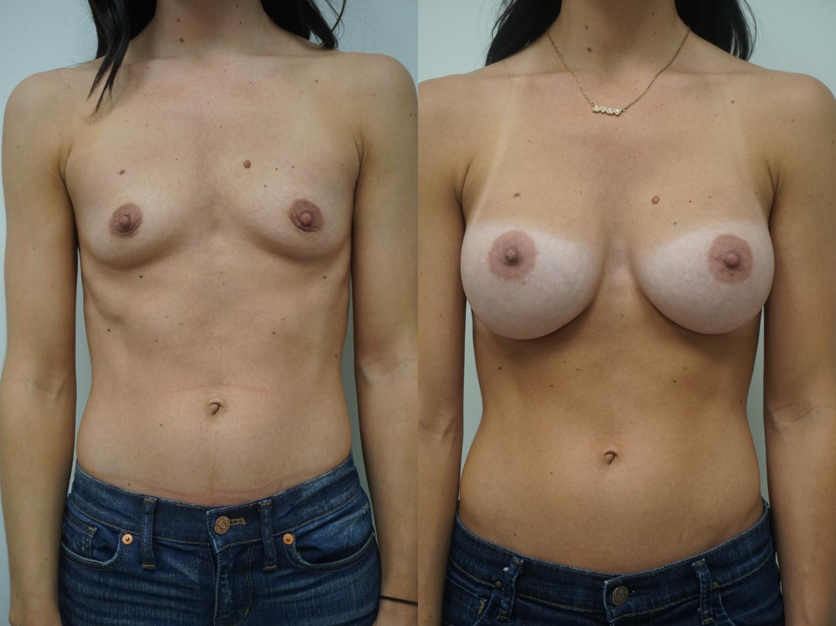 Before & After Breast Augmentation Case 168 View #1 View in Gilbert, AZ