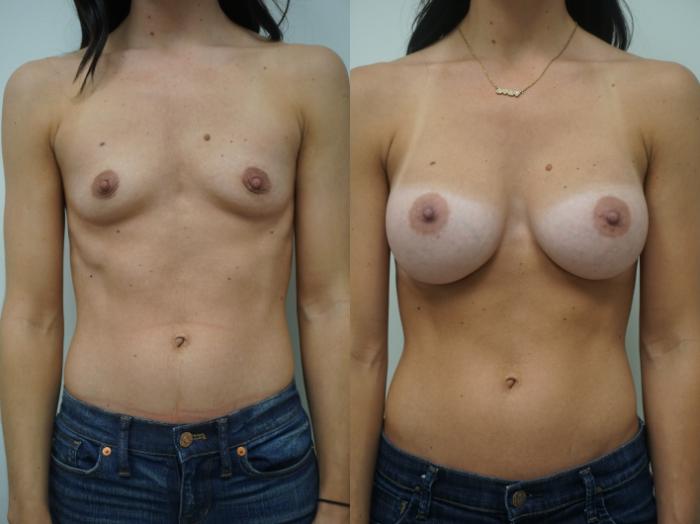 Before & After Breast Augmentation Case 168 View #1 View in Gilbert, AZ