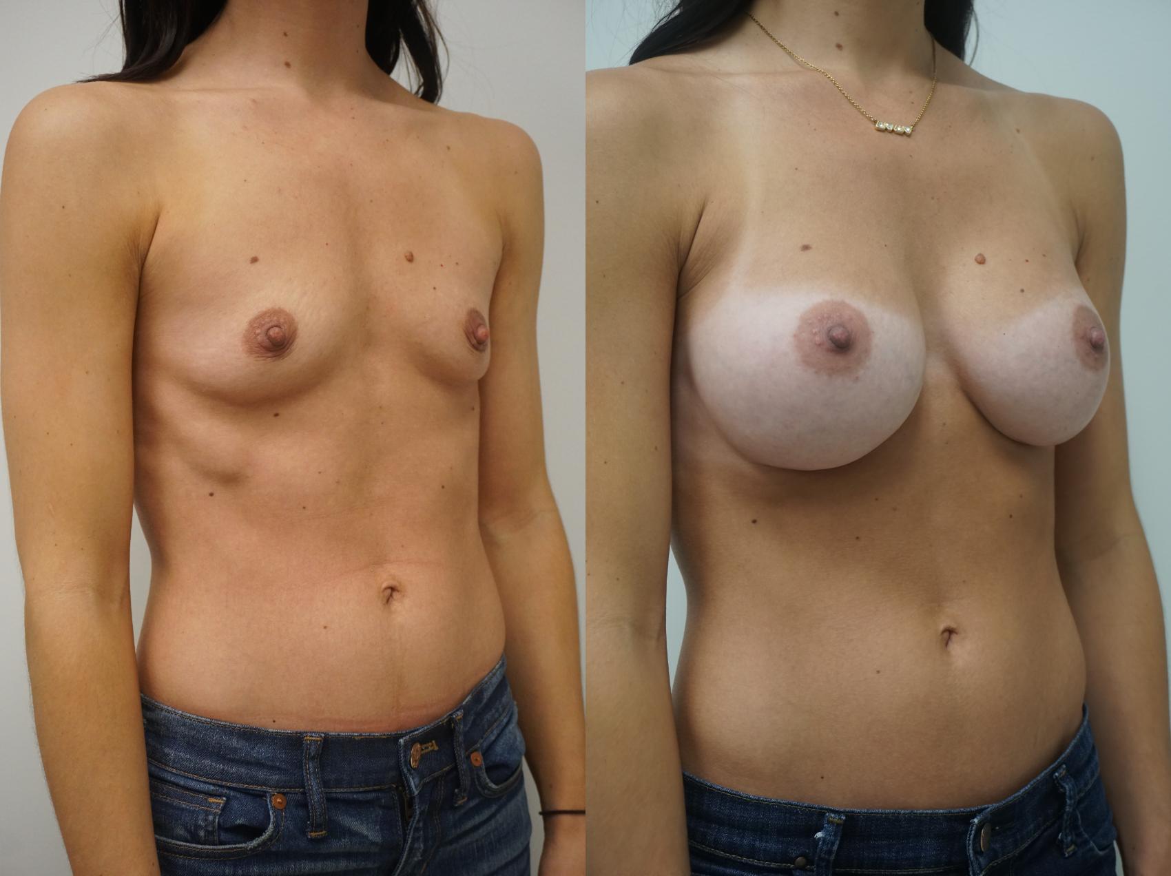 Before & After Breast Augmentation Case 168 View #2 View in Gilbert, AZ