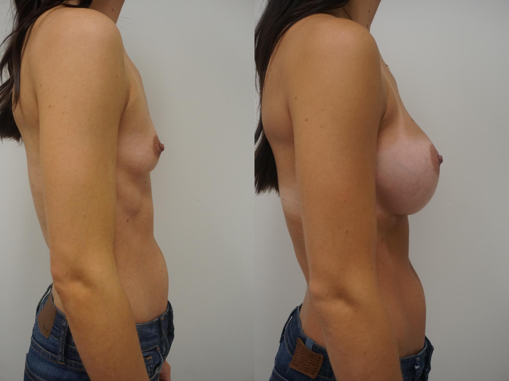 Before & After Breast Augmentation Case 168 View #3 View in Gilbert, AZ