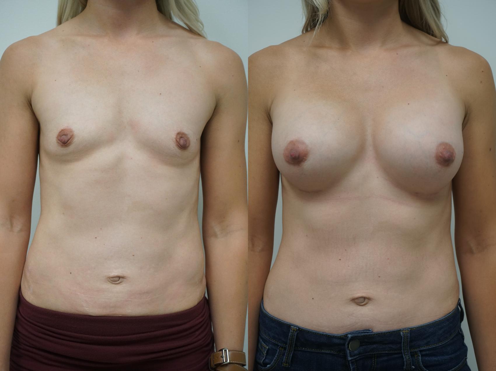 Before & After Breast Augmentation Case 169 View #1 View in Gilbert, AZ
