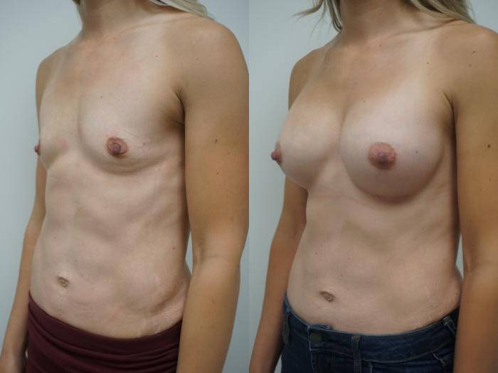 Before & After Breast Augmentation Case 169 View #2 View in Gilbert, AZ