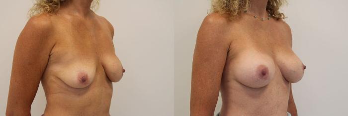 Before & After Breast Augmentation Case 17 View #1 View in Gilbert, AZ