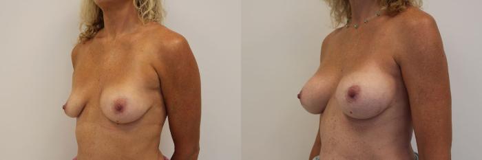 Before & After Breast Augmentation Case 17 View #2 View in Gilbert, AZ