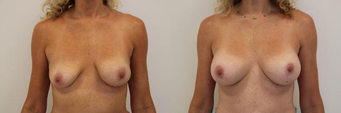 Before & After Breast Augmentation Case 17 View #3 View in Gilbert, AZ