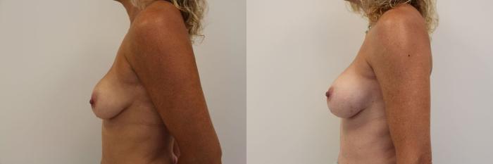 Before & After Breast Augmentation Case 17 View #4 View in Gilbert, AZ