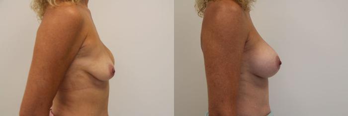 Before & After Breast Augmentation Case 17 View #5 View in Gilbert, AZ