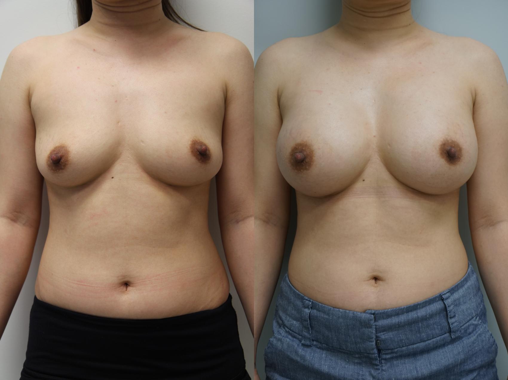 Before & After Breast Augmentation Case 175 View #1 View in Gilbert, AZ