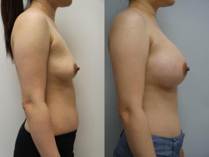 Before & After Breast Augmentation Case 175 View #2 View in Gilbert, AZ