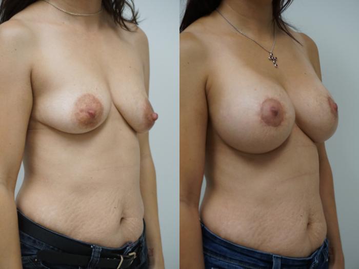 Before & After Breast Augmentation Case 177 View #2 View in Gilbert, AZ