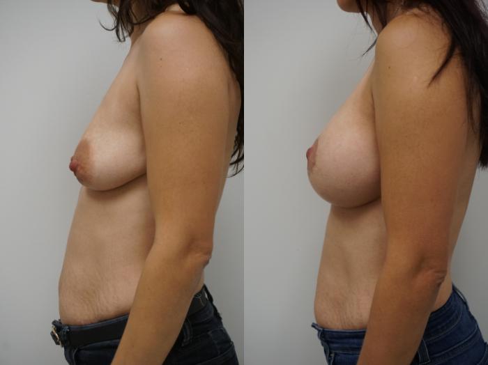 Before & After Breast Augmentation Case 177 View #3 View in Gilbert, AZ