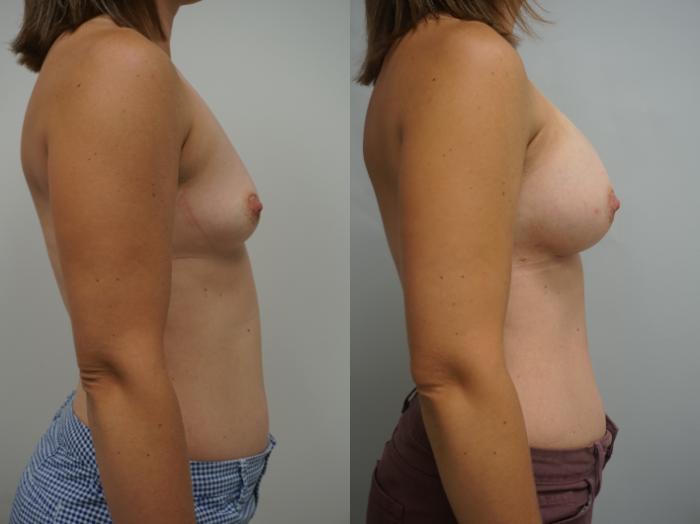 Before & After Breast Augmentation Case 178 View #1 View in Gilbert, AZ