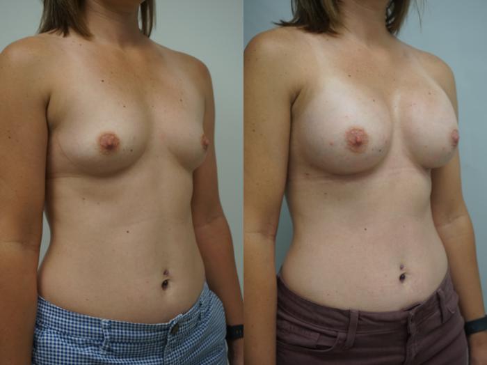 Before & After Breast Augmentation Case 178 View #2 View in Gilbert, AZ