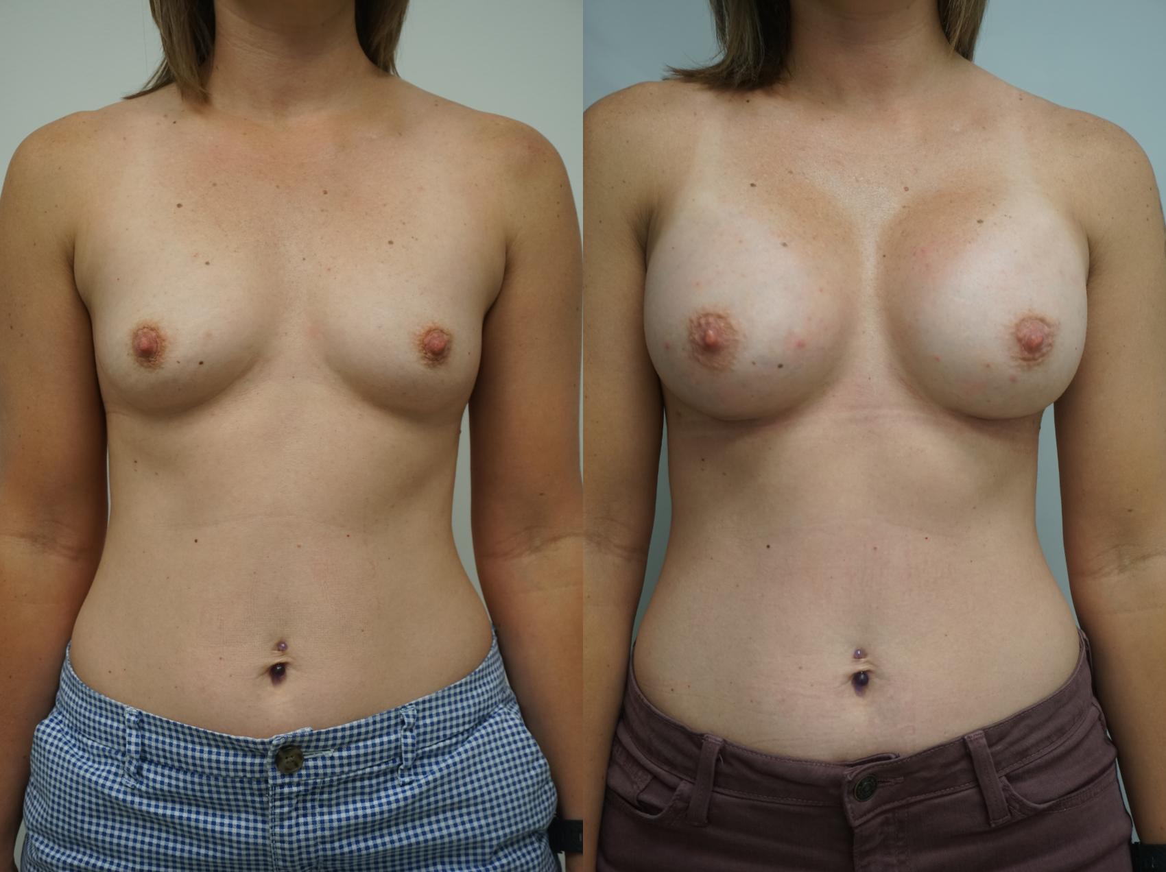 Before & After Breast Augmentation Case 178 View #3 View in Gilbert, AZ