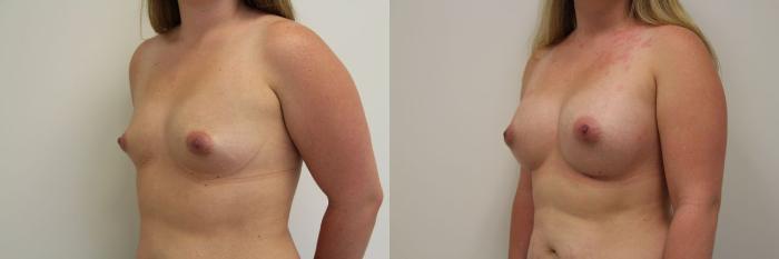Before & After Breast Augmentation Case 18 View #1 View in Gilbert, AZ