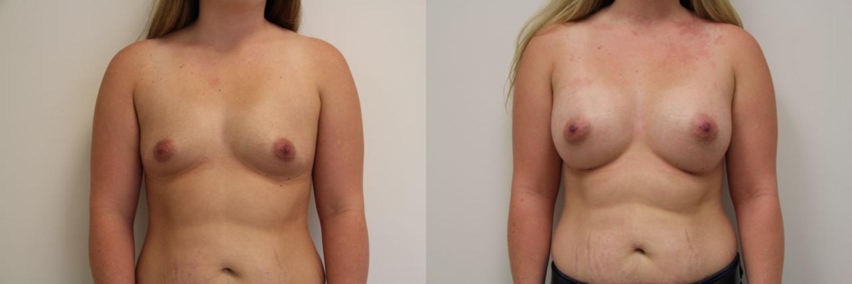 Before & After Breast Augmentation Case 18 View #2 View in Gilbert, AZ