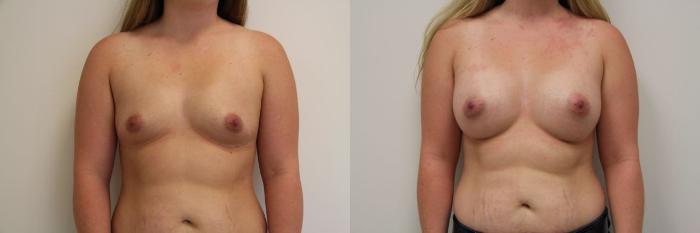 Before & After Breast Augmentation Case 18 View #2 View in Gilbert, AZ