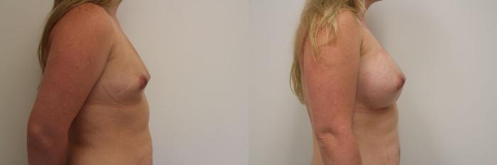 Before & After Breast Augmentation Case 18 View #3 View in Gilbert, AZ