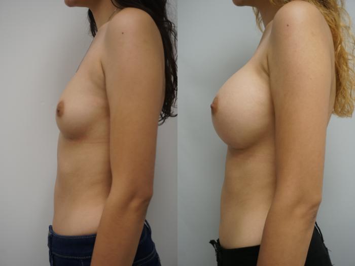 Before & After Breast Augmentation Case 180 View #1 View in Gilbert, AZ