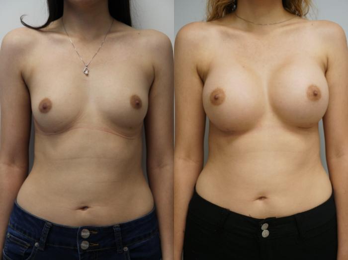 Before & After Breast Augmentation Case 180 View #2 View in Gilbert, AZ