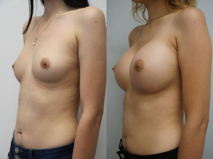 Before & After Breast Augmentation Case 180 View #3 View in Gilbert, AZ