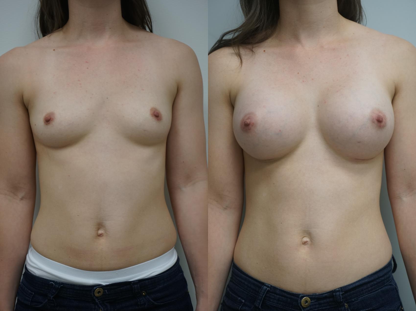 Before & After Breast Augmentation Case 181 View #1 View in Gilbert, AZ