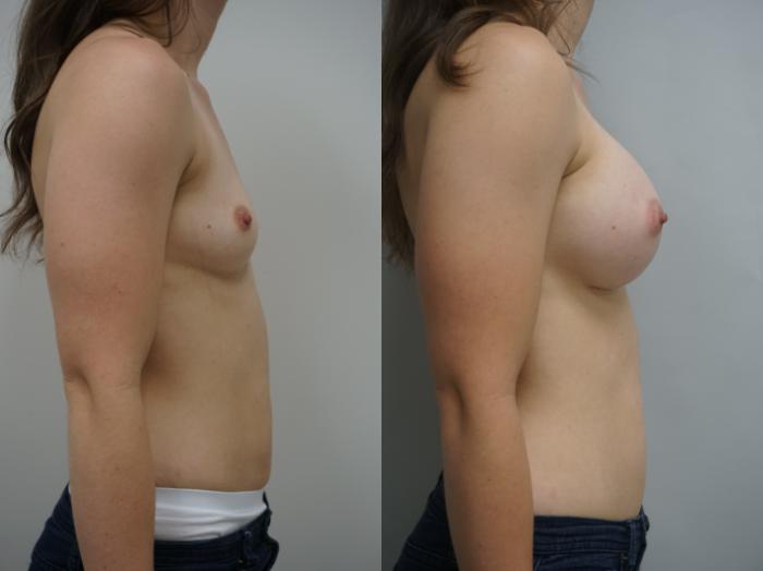 Before & After Breast Augmentation Case 181 View #2 View in Gilbert, AZ