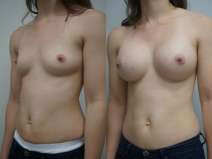 Before & After Breast Augmentation Case 181 View #3 View in Gilbert, AZ