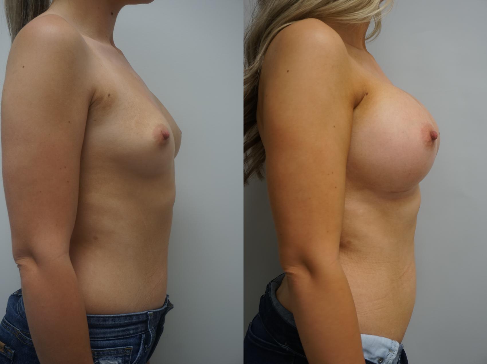 Breast Augmentation Before And After Photos