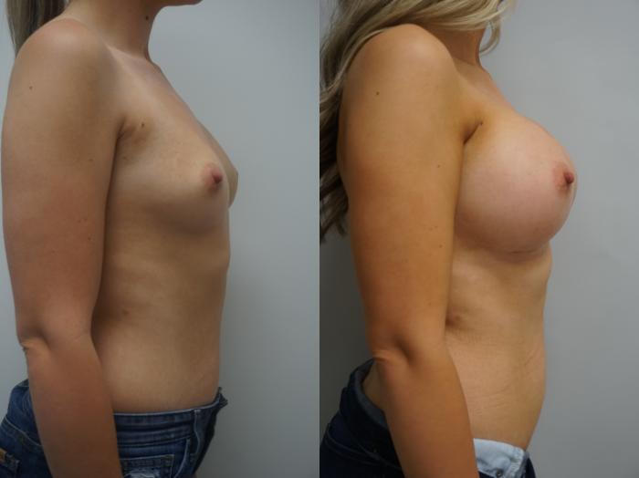 Before & After Breast Augmentation Case 182 View #1 View in Gilbert, AZ