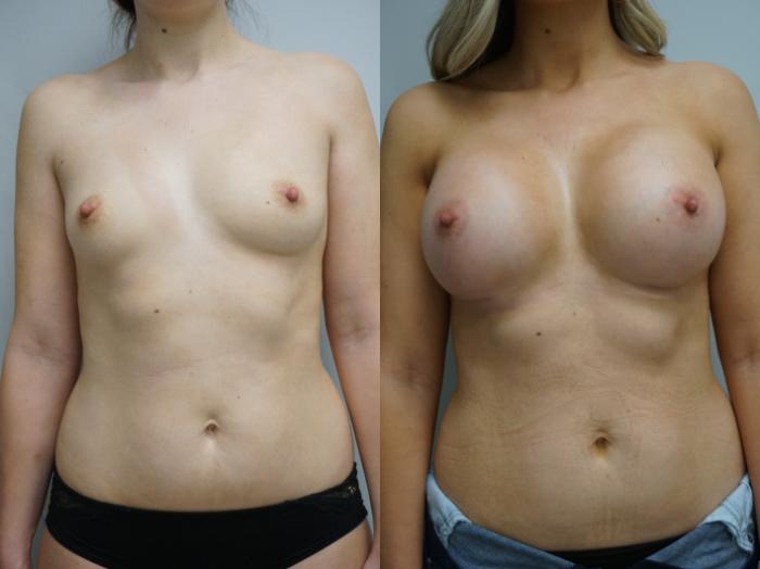 Before & After Breast Augmentation Case 182 View #2 View in Gilbert, AZ