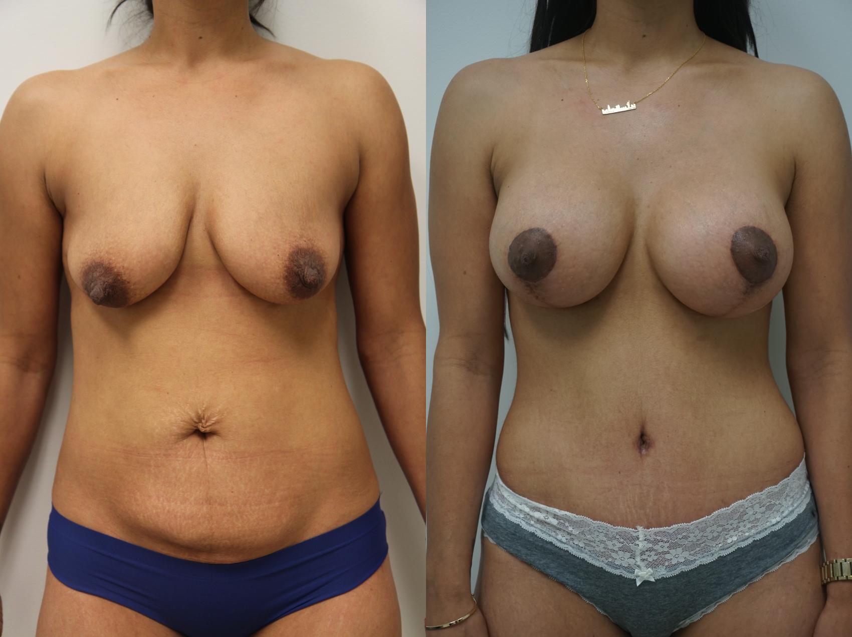 Before & After Breast Augmentation Case 185 View #1 View in Gilbert, AZ
