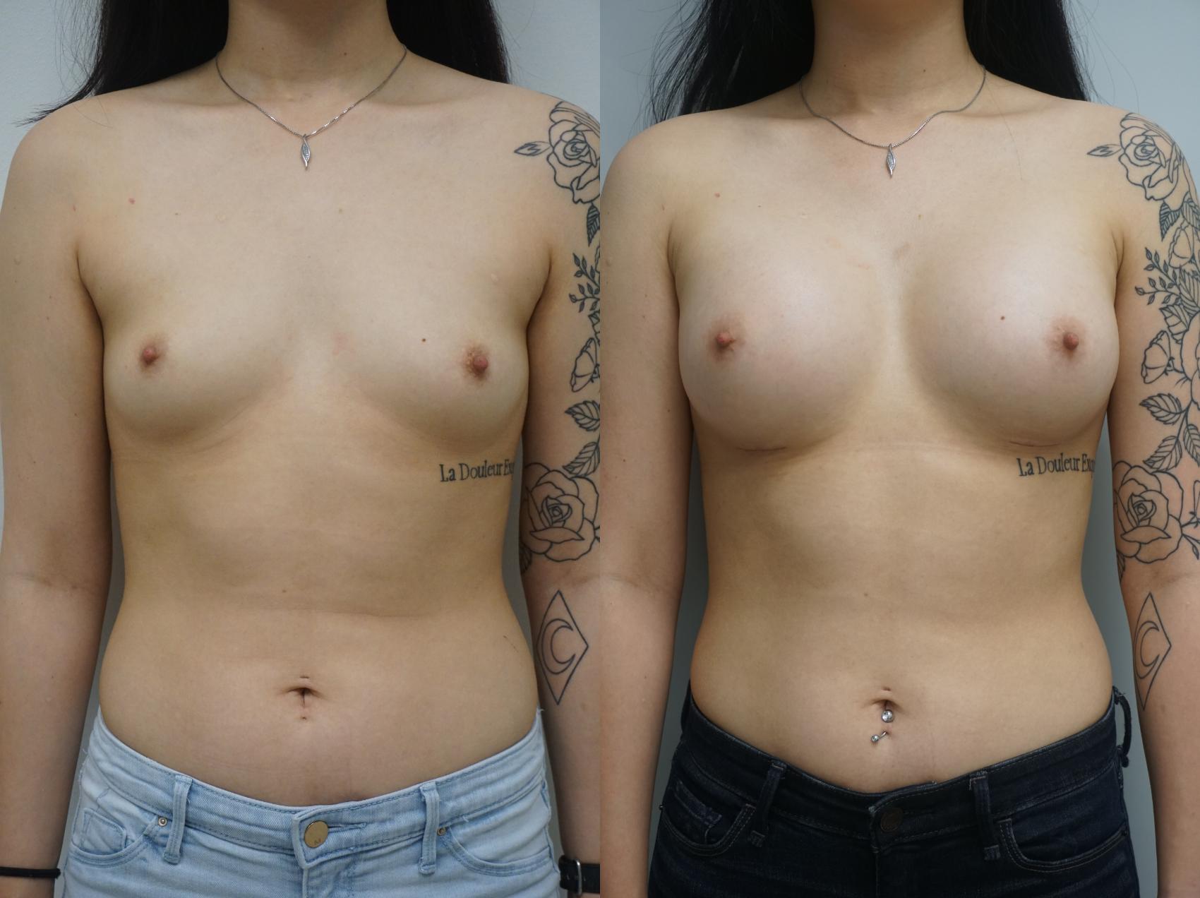 Before & After Breast Augmentation Case 188 View #1 View in Gilbert, AZ