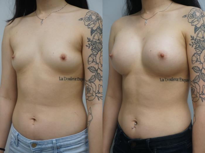 Before & After Breast Augmentation Case 188 View #2 View in Gilbert, AZ