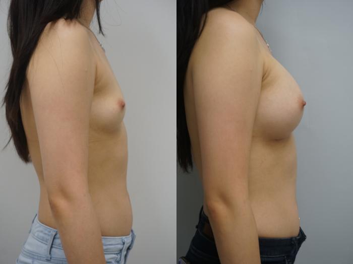 Before & After Breast Augmentation Case 188 View #3 View in Gilbert, AZ