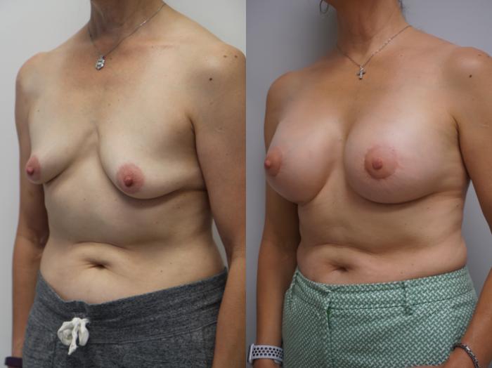 Before & After Breast Augmentation Case 189 View #1 View in Gilbert, AZ