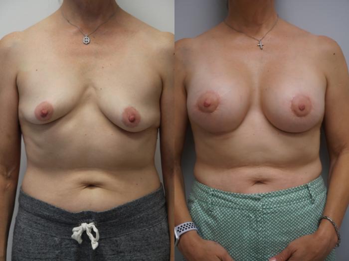 Before & After Breast Augmentation Case 189 View #2 View in Gilbert, AZ