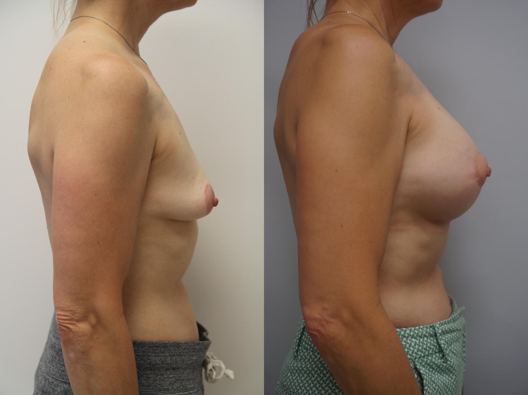 Before & After Breast Augmentation Case 189 View #3 View in Gilbert, AZ