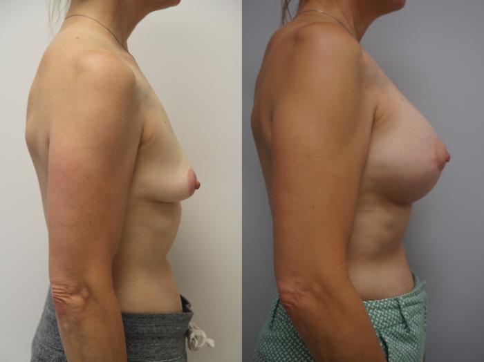 Before & After Breast Augmentation Case 189 View #3 View in Gilbert, AZ
