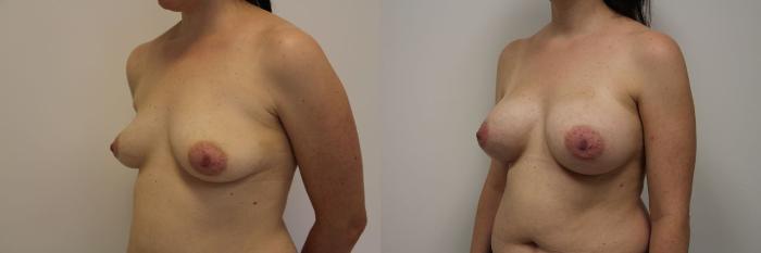 Before & After Breast Augmentation Case 19 View #2 View in Gilbert, AZ